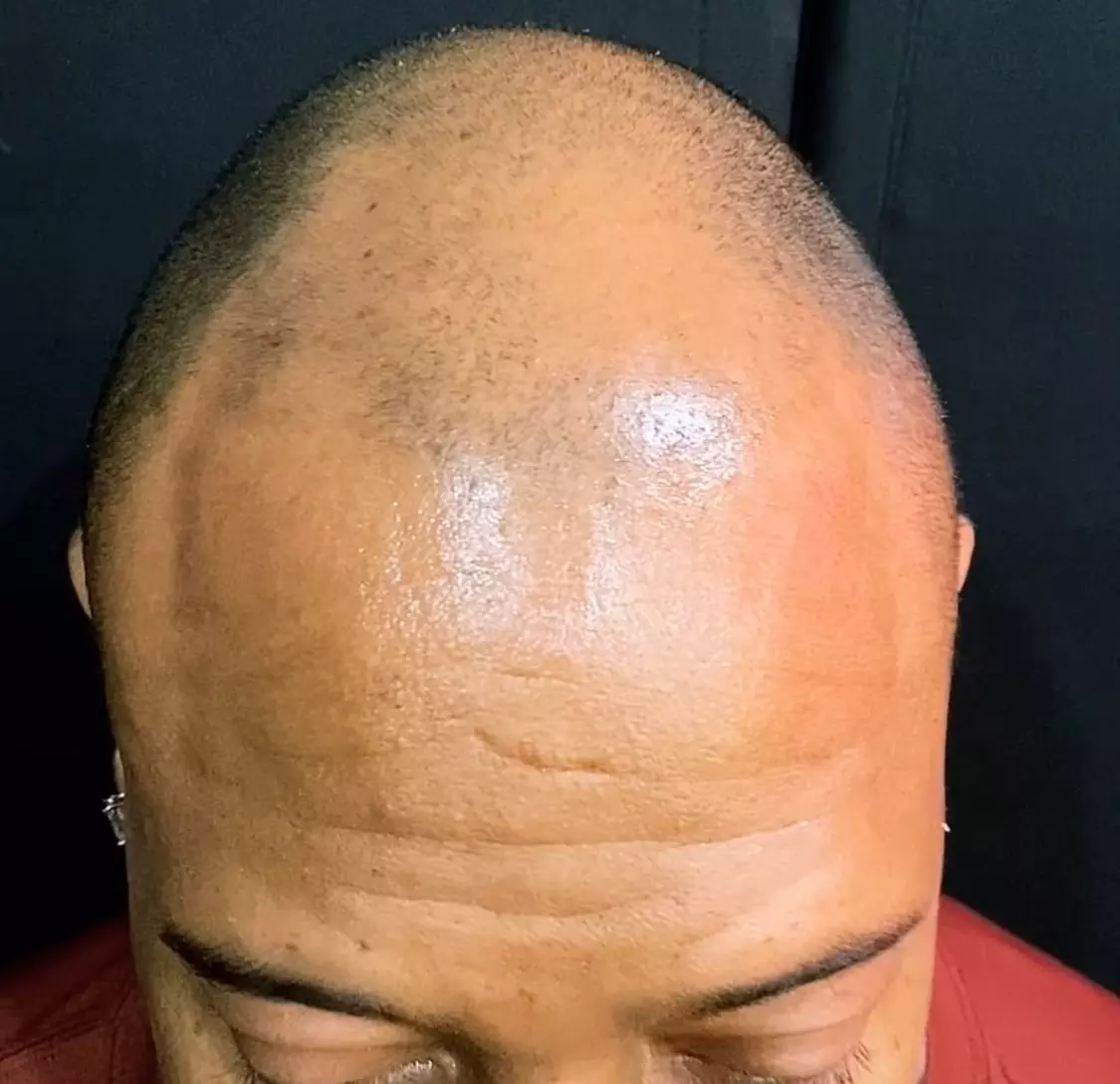 Scalp Micro Pigmentation Sessions for Hair Restoration