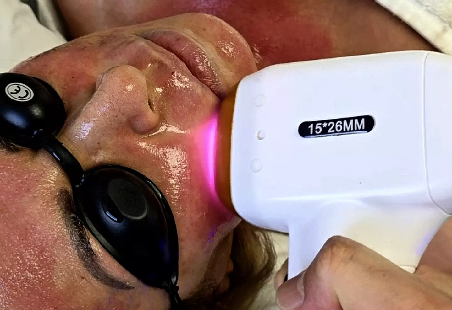 Up to 58% Off on Micro-Needling at Dr. Kwang Lee Wellness Center INC