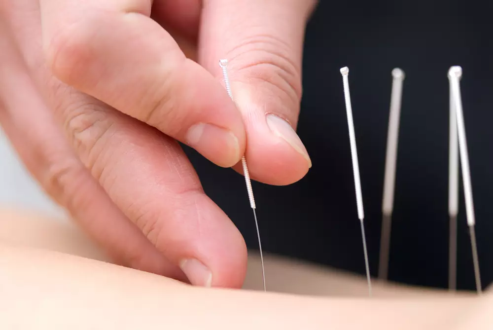 Explore Ace Wellness Center's Acupuncture with Tui Na or Weight Management Sessions, offering up to 65% off - Primary Image