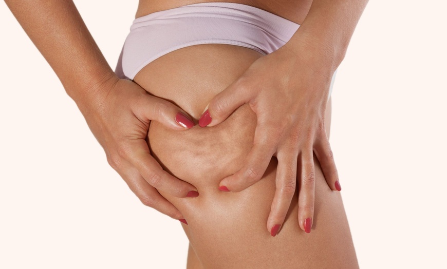 Image 3: Up to 64% Off on Fat / Cellulite Reduction - Non-Branded at UK Aesthetics Lounge