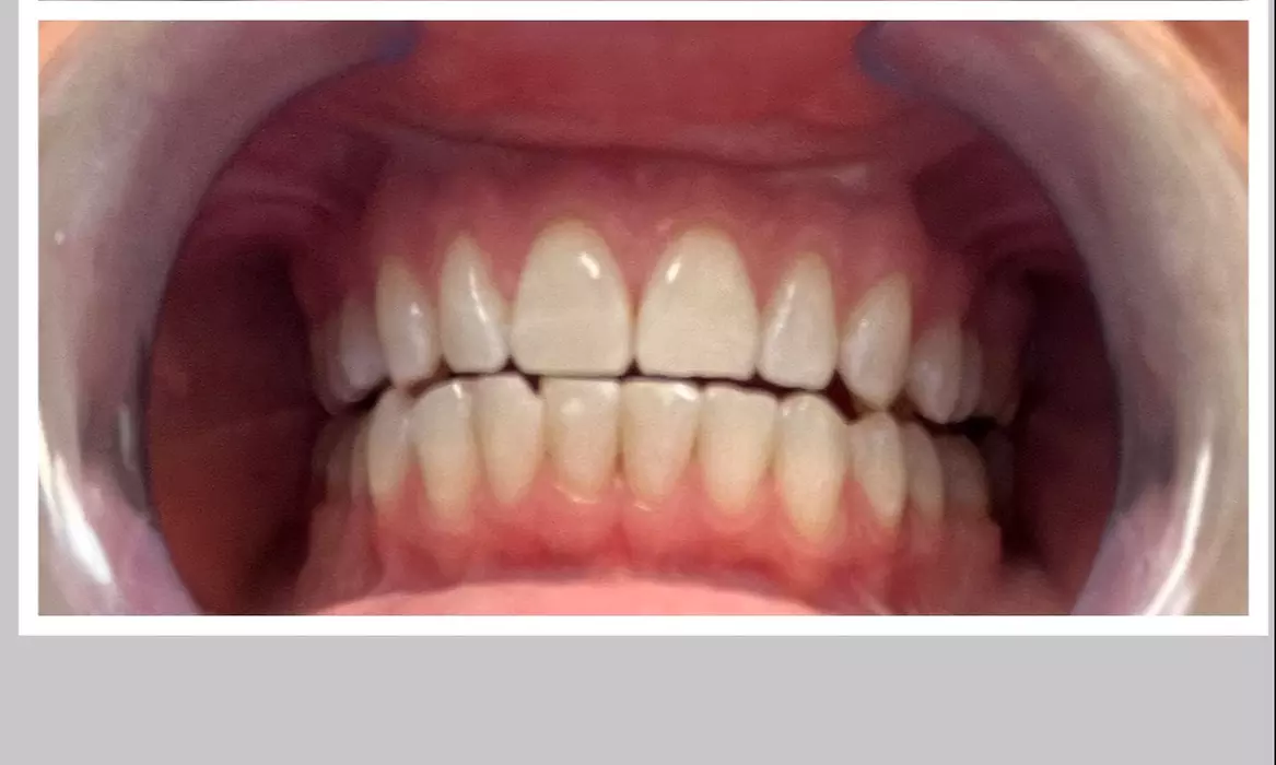 Up to 10% Off on Teeth Whitening - In-Office - Non-Branded at Glamorous Glo - Primary Image