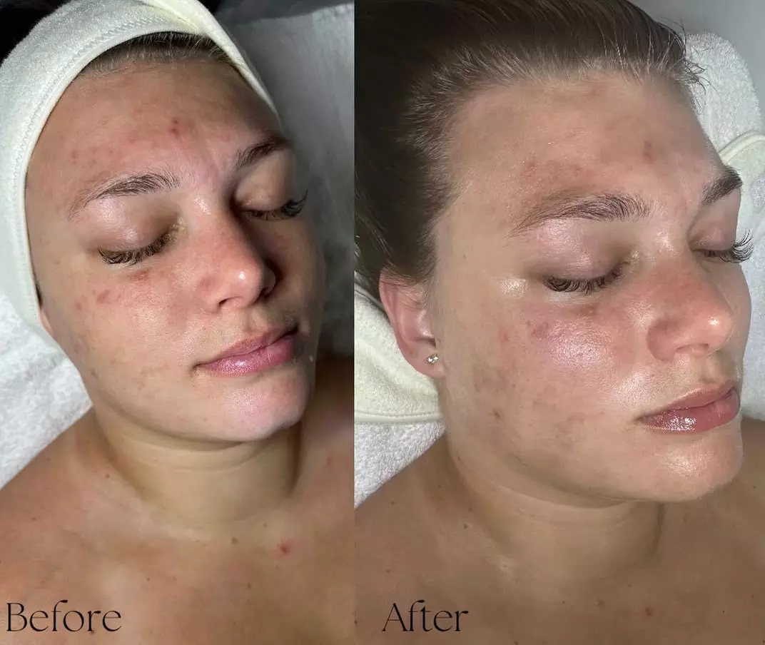 Up to 20% Off on Facial - Chosen by Customer at Sky Rain Skincare - Second Medium