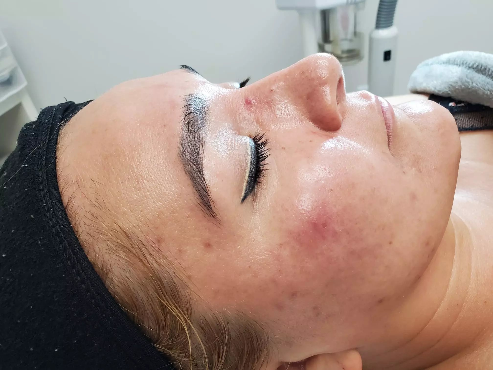 Clear Skin Journey: Acne Treatment Sessions to Transform Your Skin