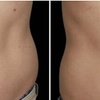 Image 5: Fat / Cellulite Reduction - Non-Branded at Dpz parlour