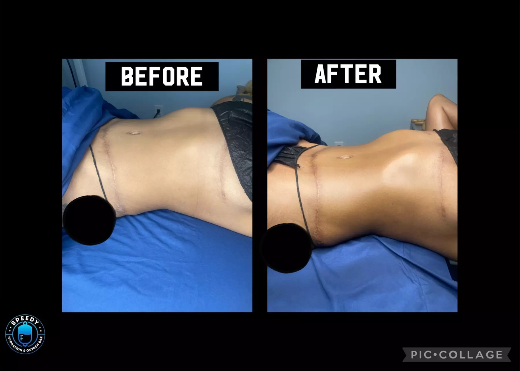 Up to 47% Off on Lymphatic Drainage Massage at Speedy Hydration & Wellness