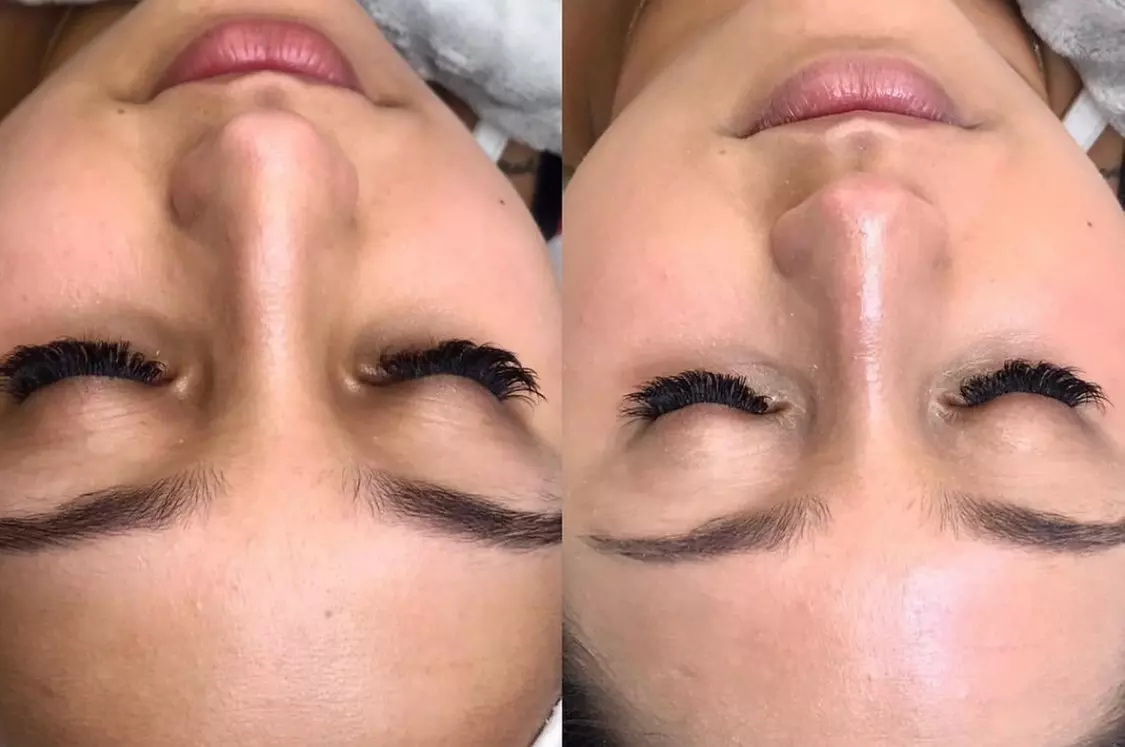 Up to 40% Off on Facial at All in Beauty Institute and Spa Miami - Second Medium