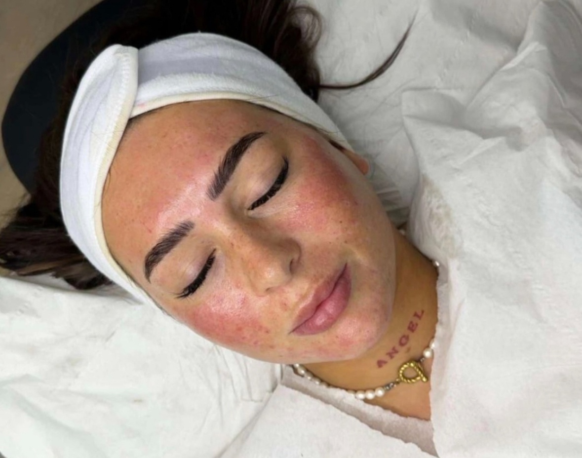 Unlock Radiant Skin: Experience the Magic of Micro-Needling Today!