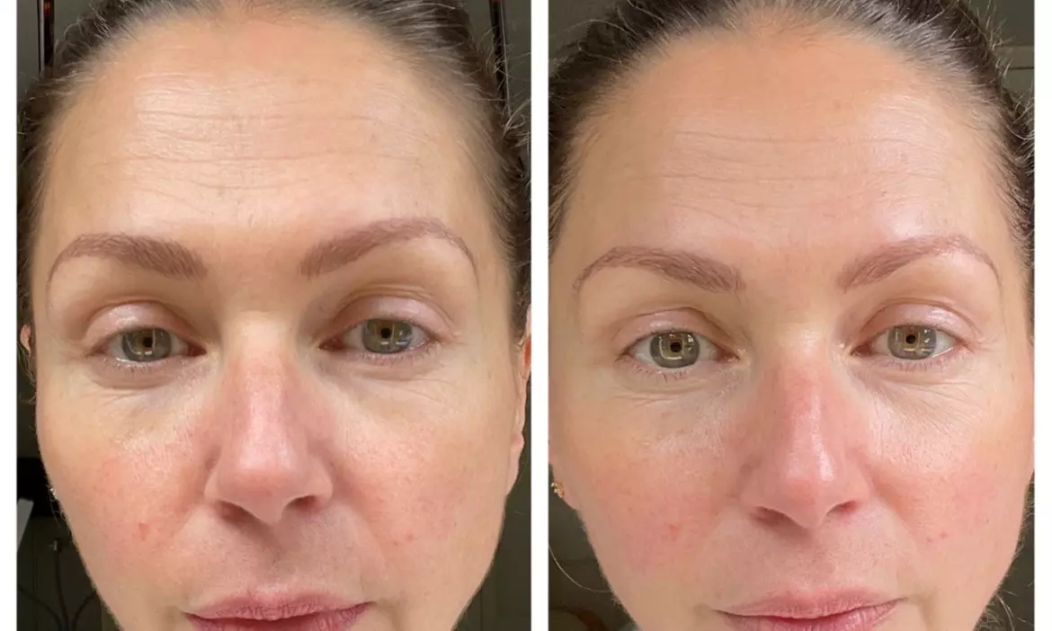 Up to 55% Off on Micro-Needling at UK Aesthetics Lounge