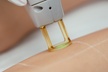 Up to 76% Off on Laser Hair Removal at Hollywood Laser Med Spa - Second Medium