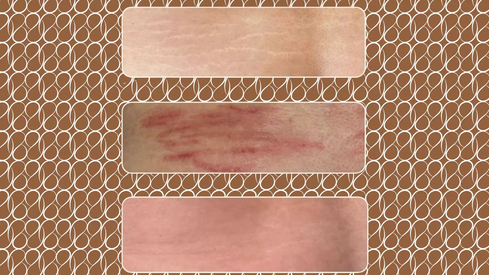 Three DermaLiss Stretch Mark Treatment Sessions – Small to XL Areas