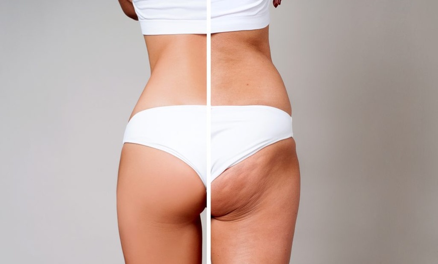 Image 4: Up to 52% Off on Fat / Cellulite Reduction - Non-Branded at UK Aesthetics Lounge