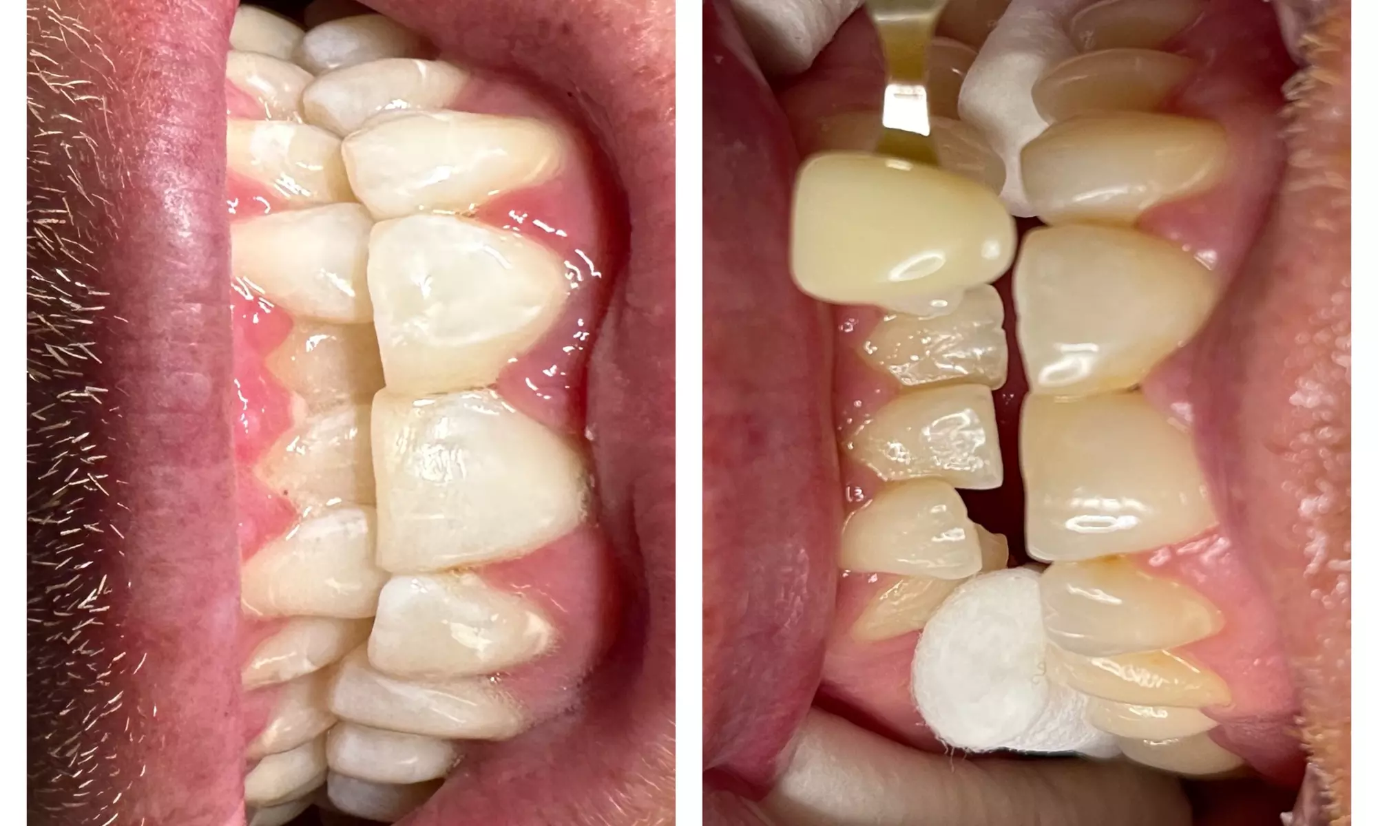 Discover Skinful beauty's teeth whitening options for one or two sessions with up to 50% off, enhancing your smile's brilliance - Primary Image