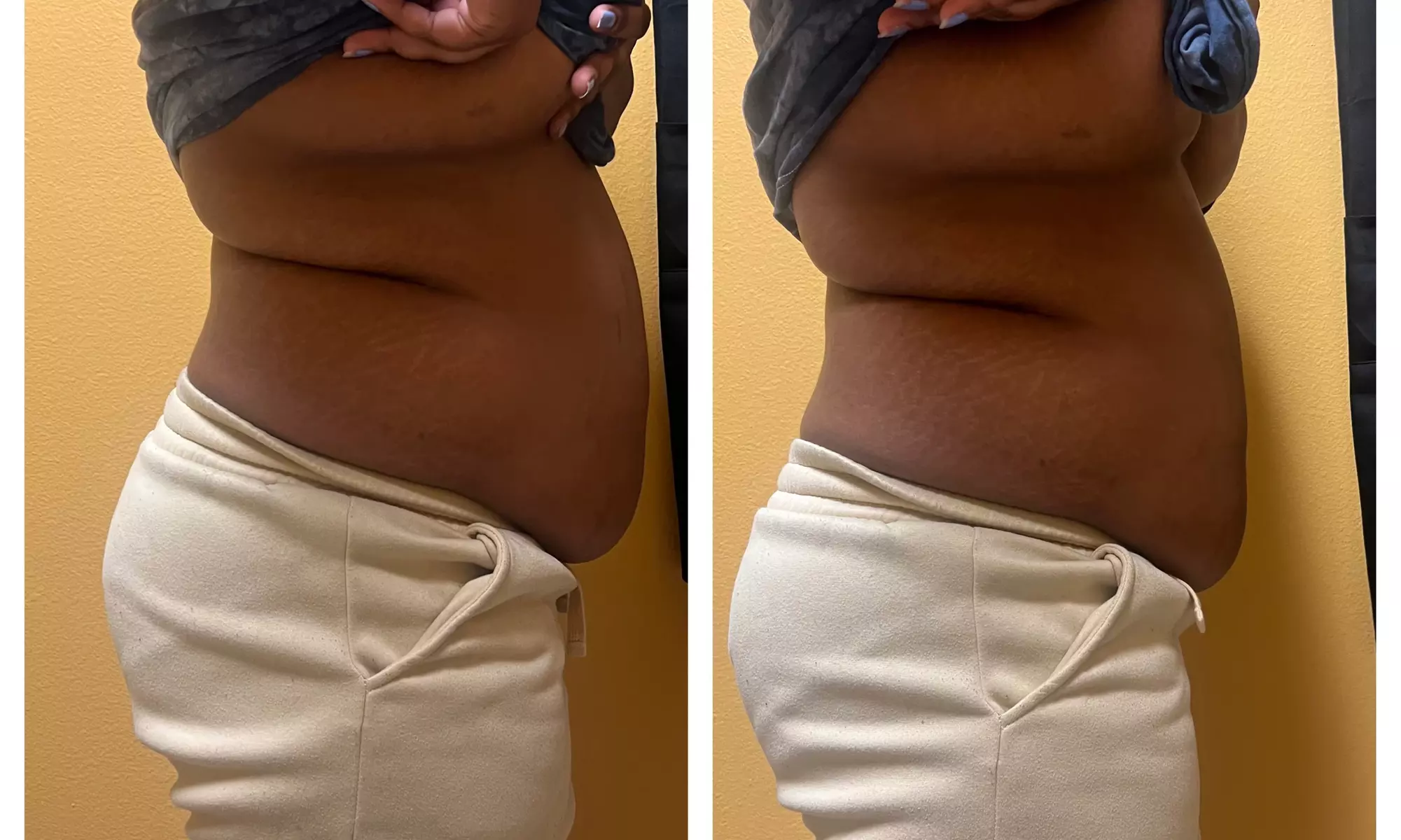 Up to 60% Off on Cavitation at Dyamond sculpted