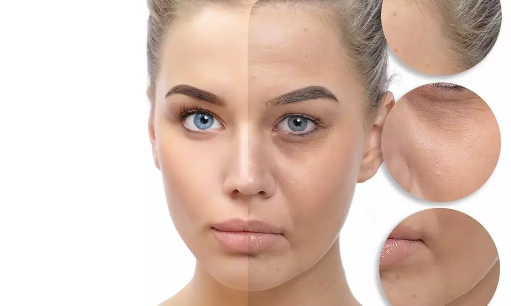 Up to 50% Off on Facial - Chosen by Customer at IBL LASER