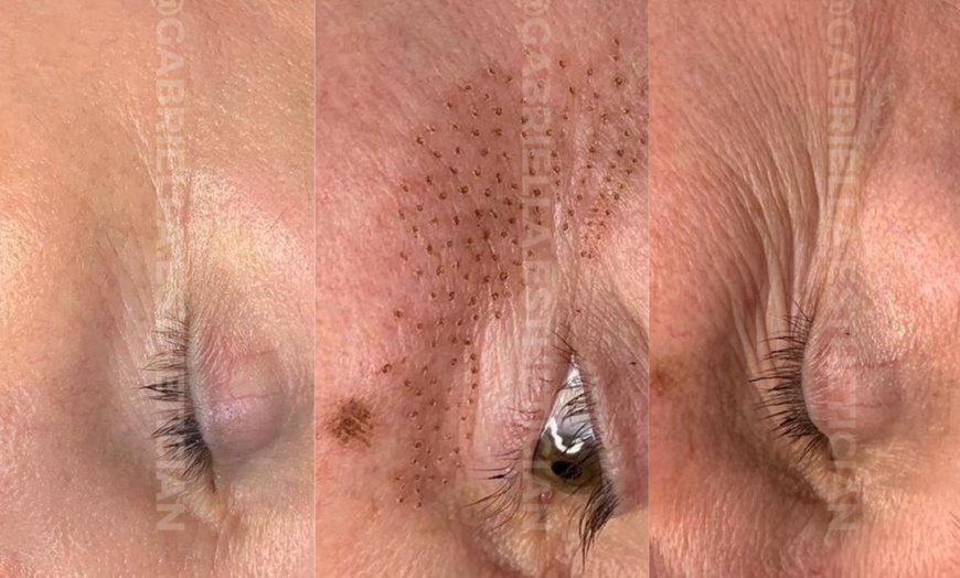 Image 6: Fibroblast Plasma Pen Lifts for Face and Neck