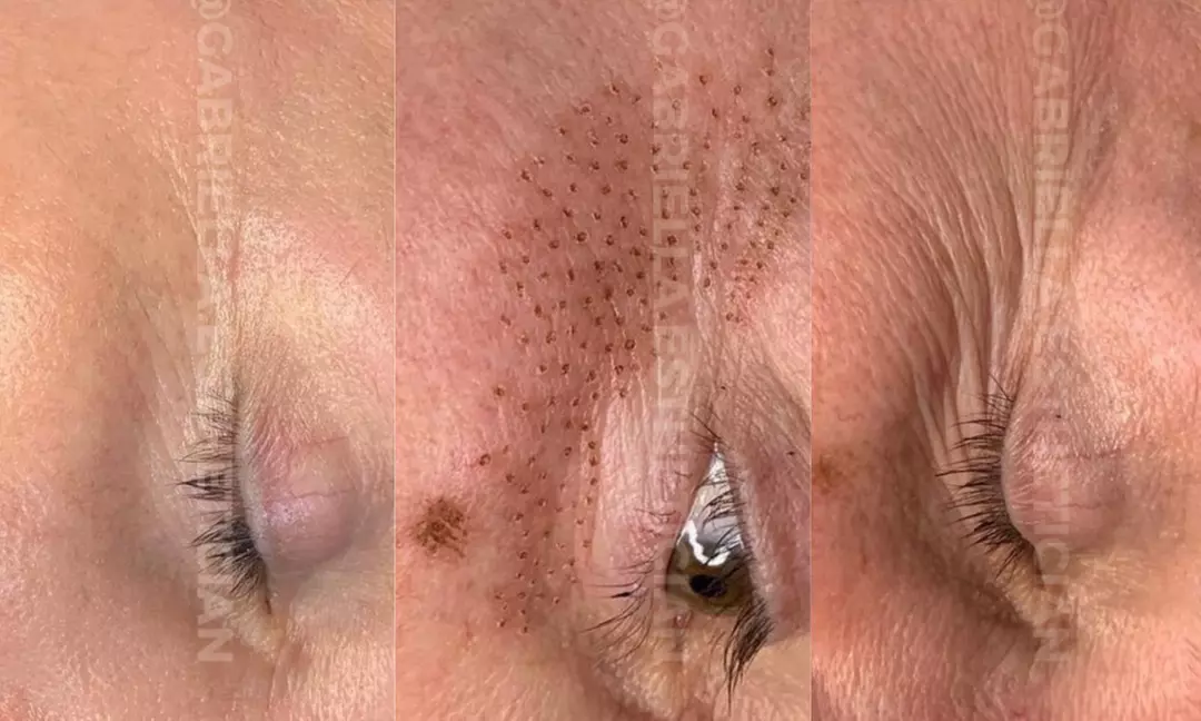 Fibroblast Plasma Pen Lifts for Face and Neck