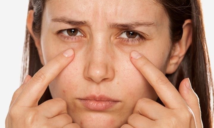 Up to 58% Off on Dark Circle / Under Eye Treatment at Aesthetics By Shanty