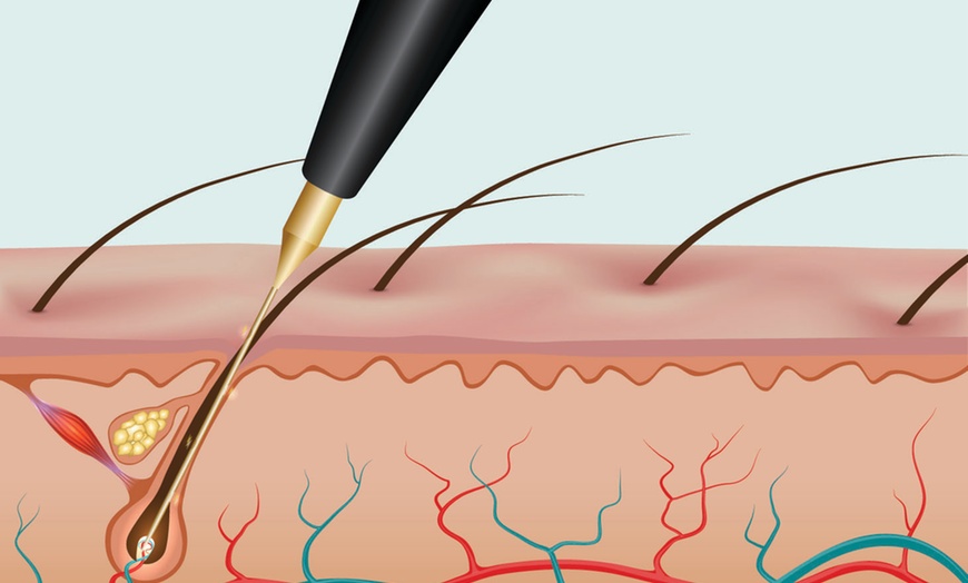 Image 4: Get Smooth Skin: Electrolysis Hair Removal Session
