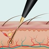 Image 4: Get Smooth Skin: Electrolysis Hair Removal Session