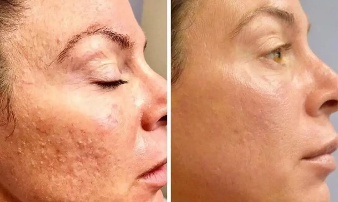 Up to 58% Off on Micro-Needling at Dr. Kwang Lee Wellness Center INC