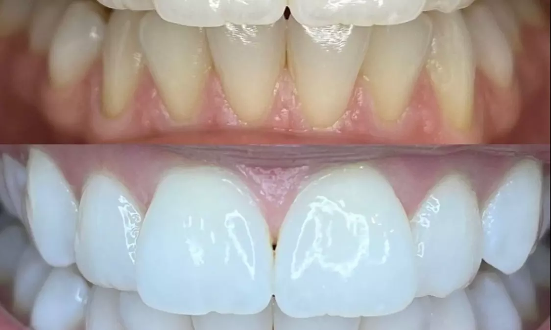 Up to 40% Off on Teeth Whitening at Perfect Lash