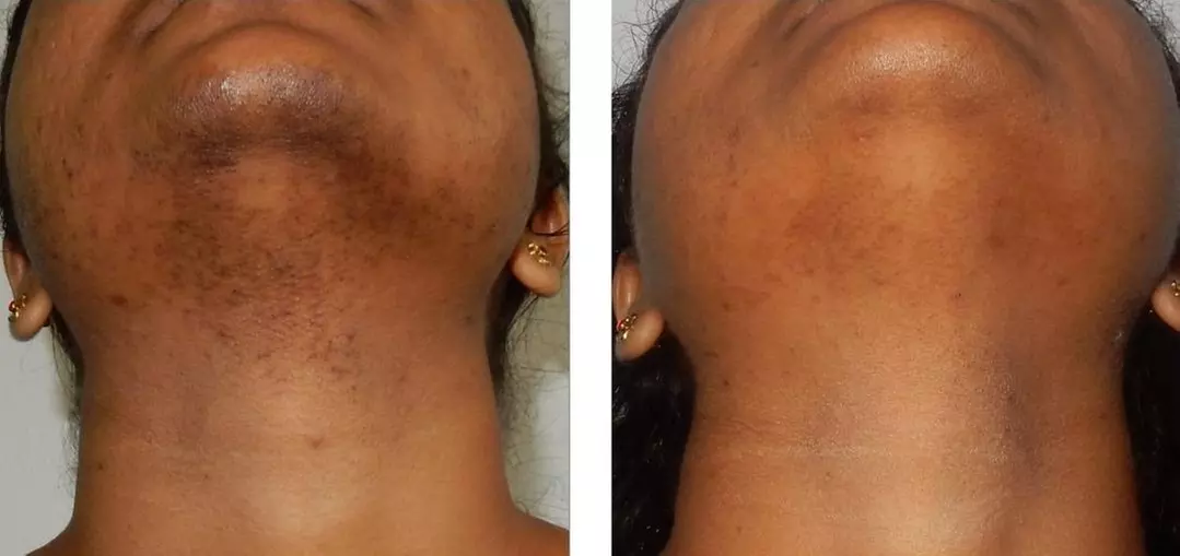 Up to 35% Off on Laser Hair Removal at Dreamfillz - Primary Image