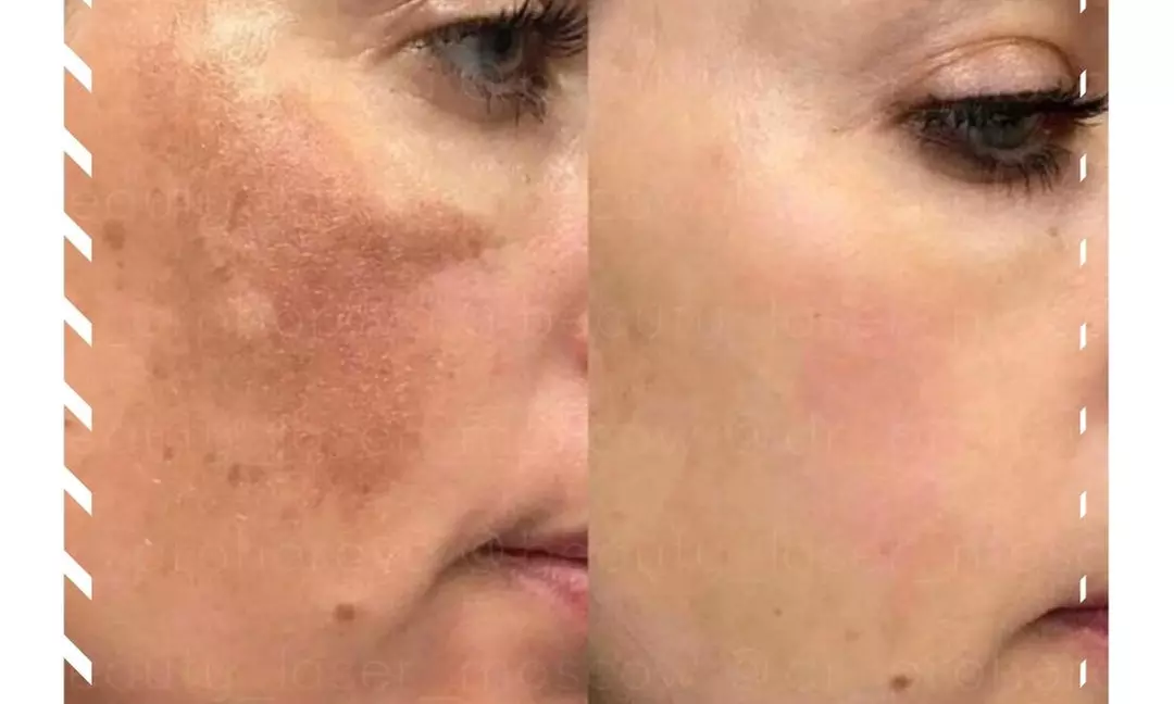 Up to 66% Off on Facial - Chemical Peel at UK Aesthetics Lounge