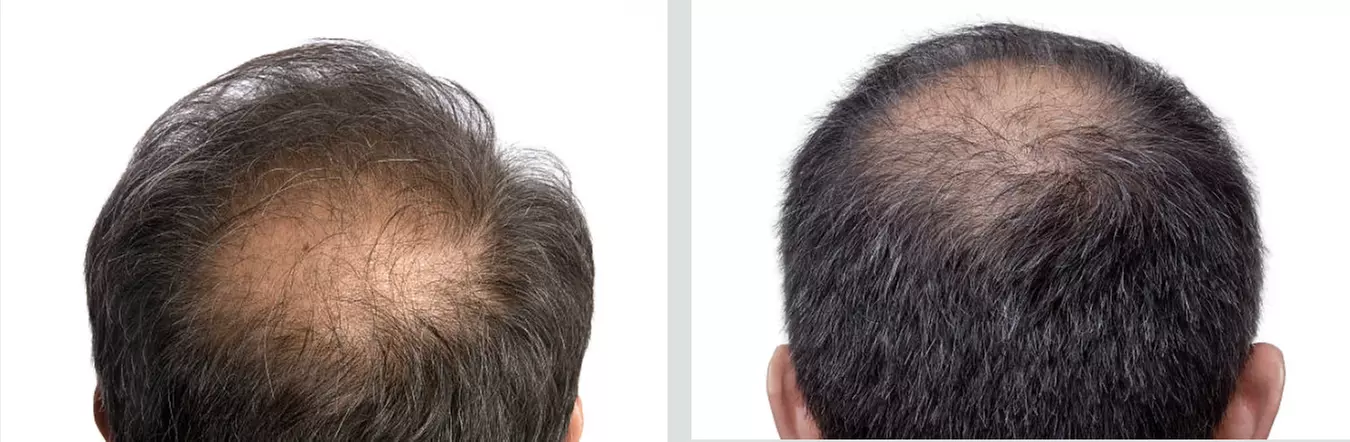 Experience Chicago Med Spa's PRP and Laser Hair Therapy Treatments for Up to 70% Off - Primary Image