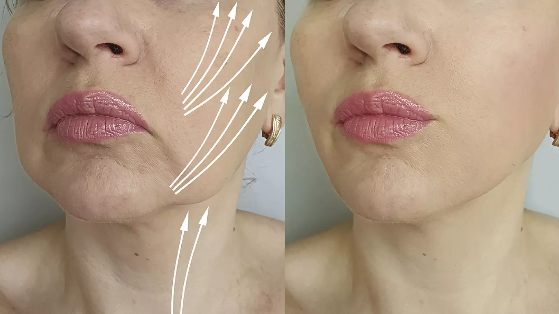 Celebrity-Coveted Cheek Pop or Snatched Jawline with PDO Threads