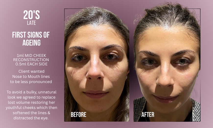 Image 3: Up to 38% Off on Injection - Dermal Filler at Divine Aesthetics Clinic London