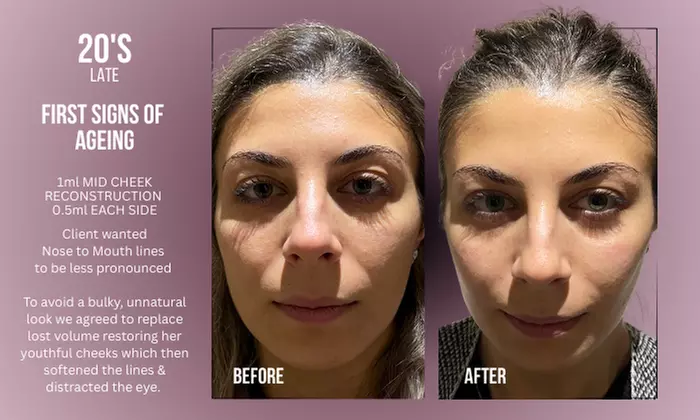 Up to 38% Off on Injection - Dermal Filler at Divine Aesthetics Clinic London