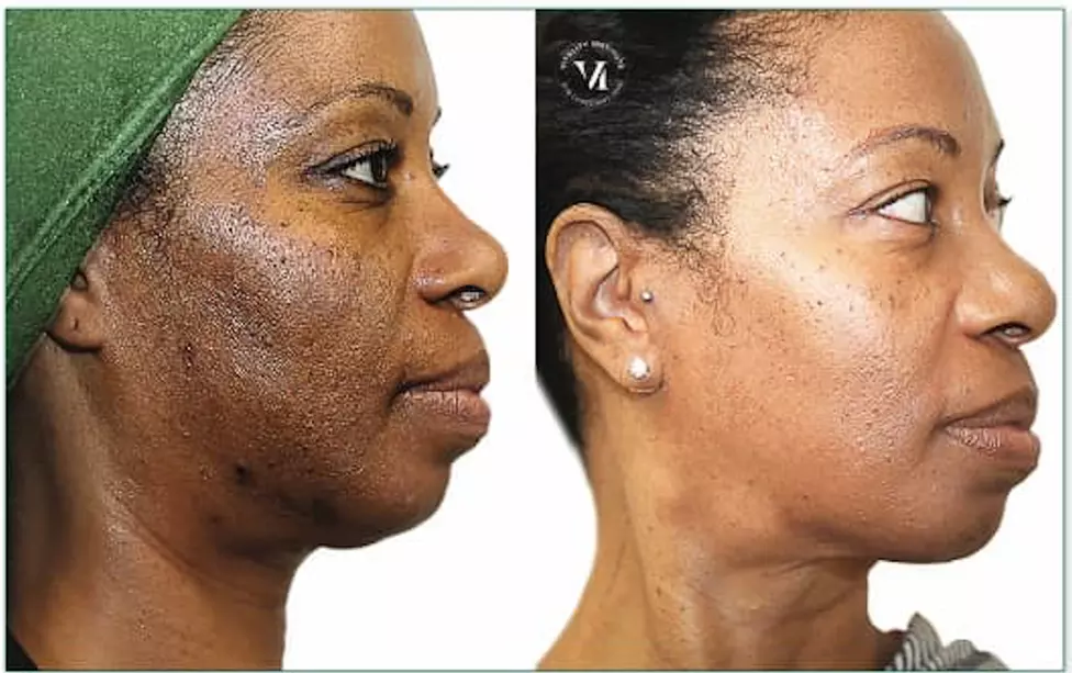 Up to 56% Off on Chemical Peel at Midtown Laser Spa 2 - Primary Image