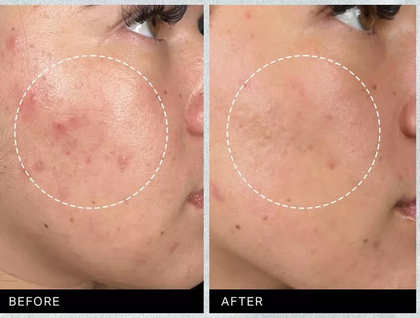 Experience the 7-Step Hydrafacial for Radiant Skin