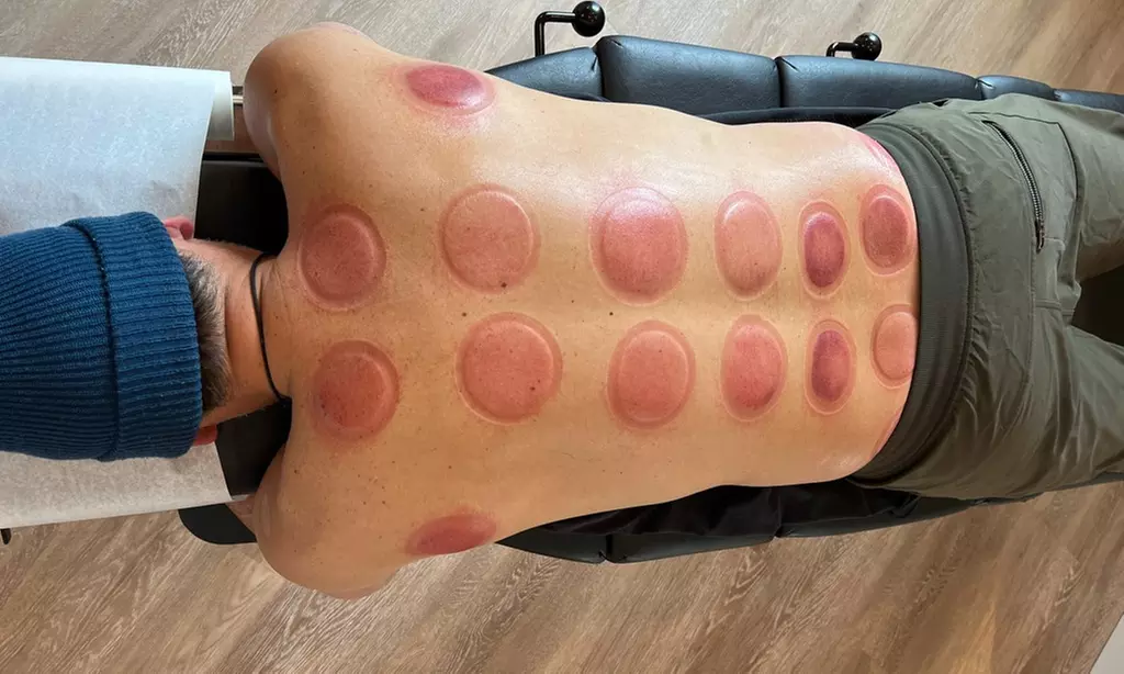 Up to 45% Off on Cupping at Wellness for Life - Second Medium
