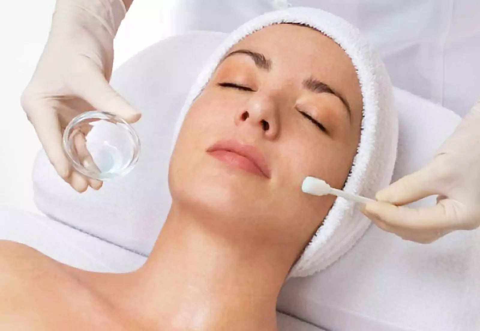 One Microneedling Session for Cellulite/Stretch Marks