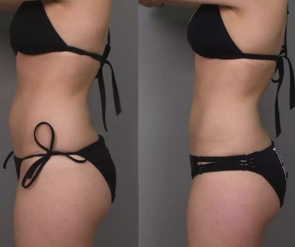 “Tone, Contour, Tighten & Glow with Laser Lipo, Ultrasonic Cavitation & RF Treatment!