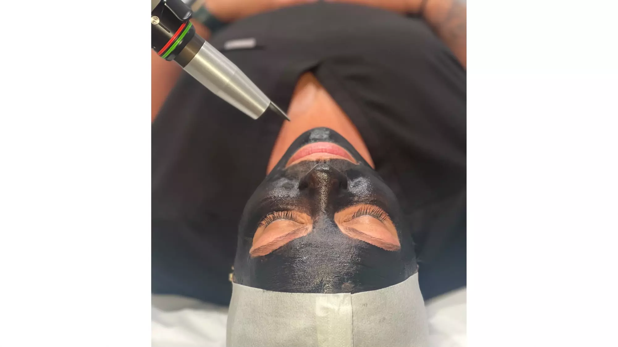 Experience the rejuvenating Carbon Laser Peel at Louisville Laser and Spa with up to 40% off, for a glowing complexion - Primary Image