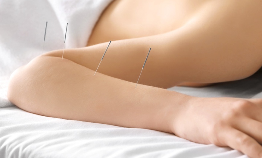 Image 4: Up to 34% Off on Acupuncture Services at United Kingdom