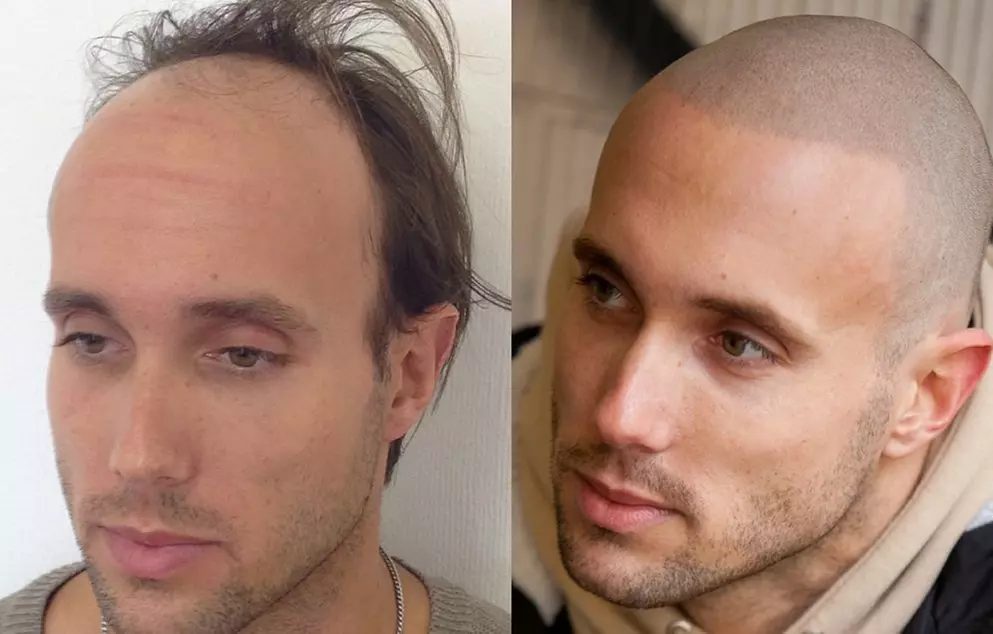 Up to 20% Off on Hair Restoration - Non-Surgical at Divine Glow Aesthetics & Beauty Spa - Primary Image