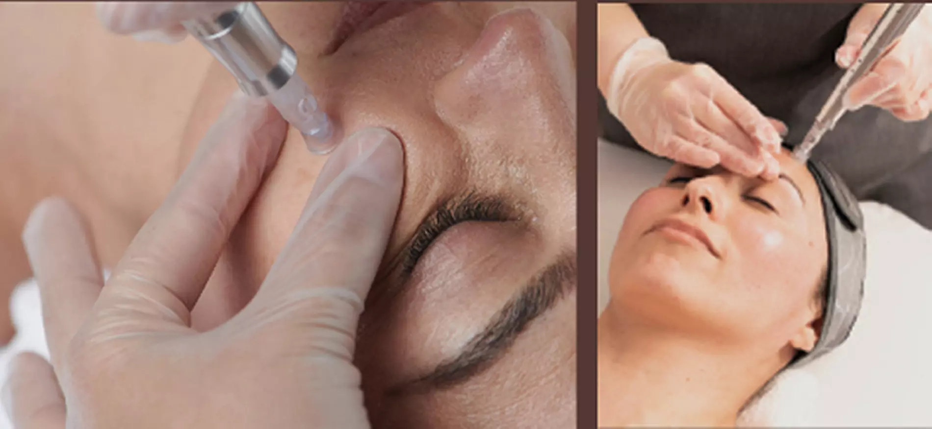 Rejuvenate with Dermaplane & Micro-Needling Treatment Options