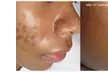 Up to 54% Off on Microdermabrasion at Derma Laser Spas - Second Medium
