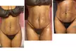 Up to 60% Off on Fat Reduction - Non-Branded at Beauty By Drea Renae - Second Medium