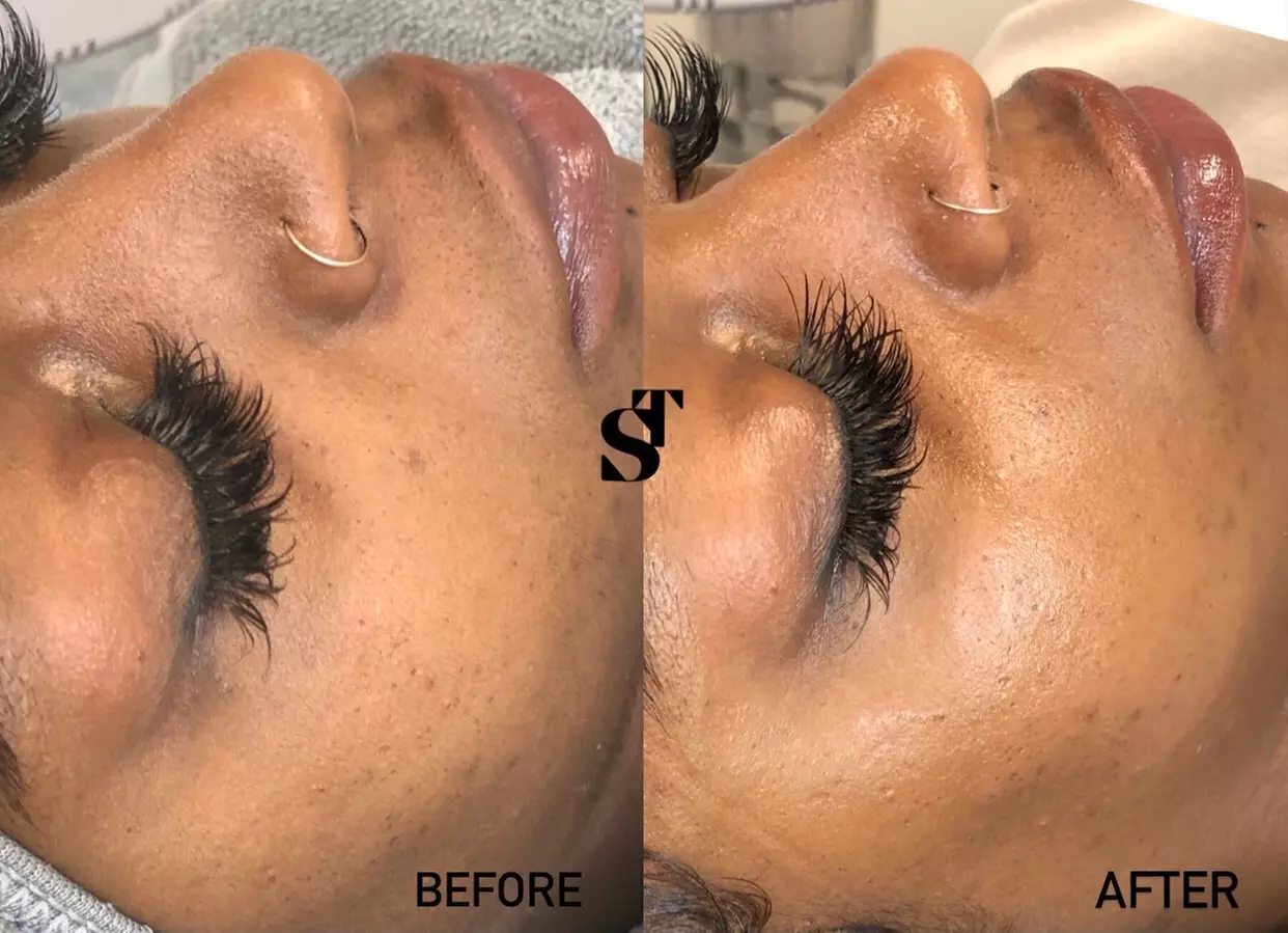 Up to 22% Off on Micro-Needling at Skin Therapy - Second Medium