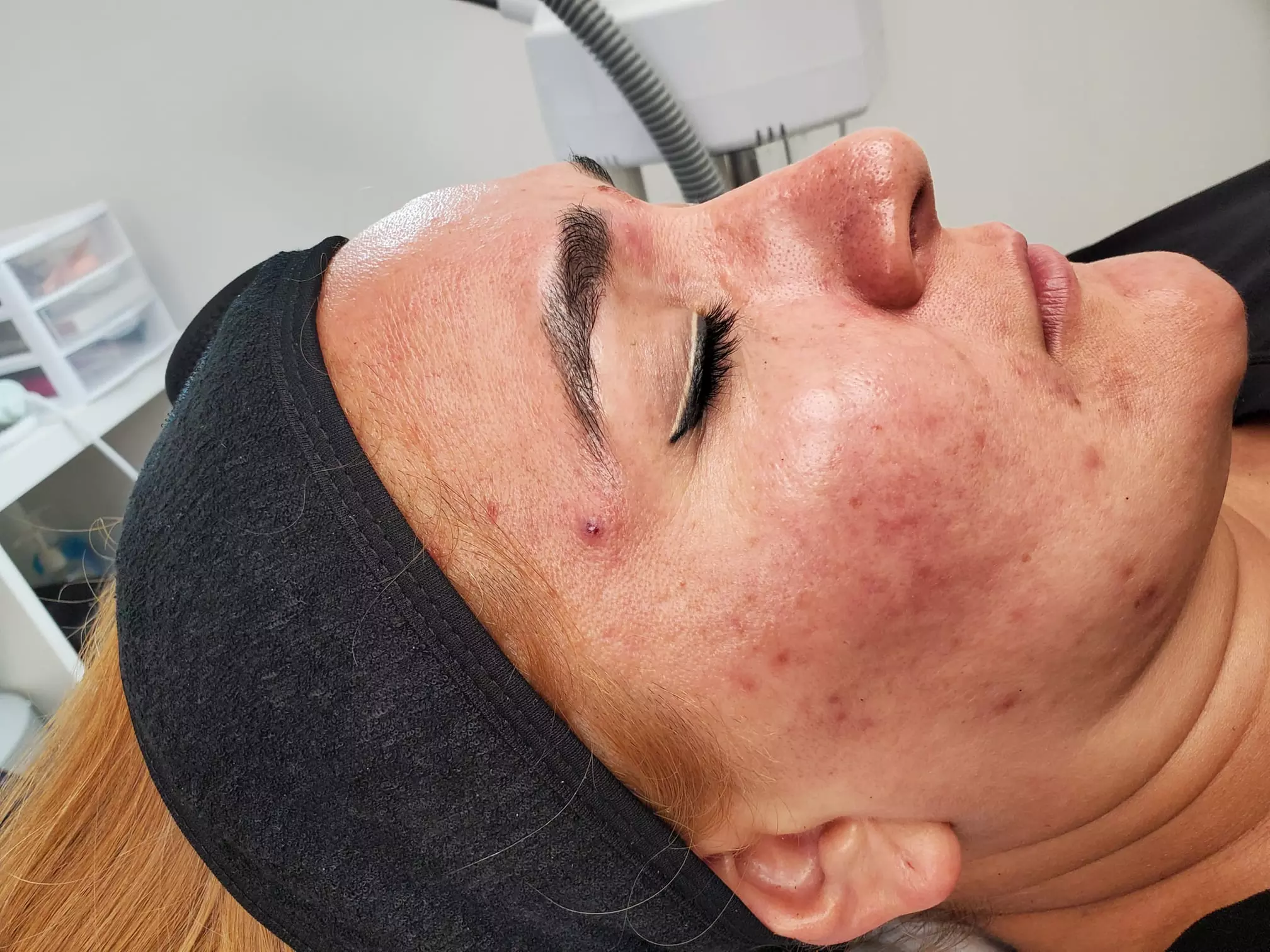 Clear Skin Journey: Acne Treatment Sessions to Transform Your Skin