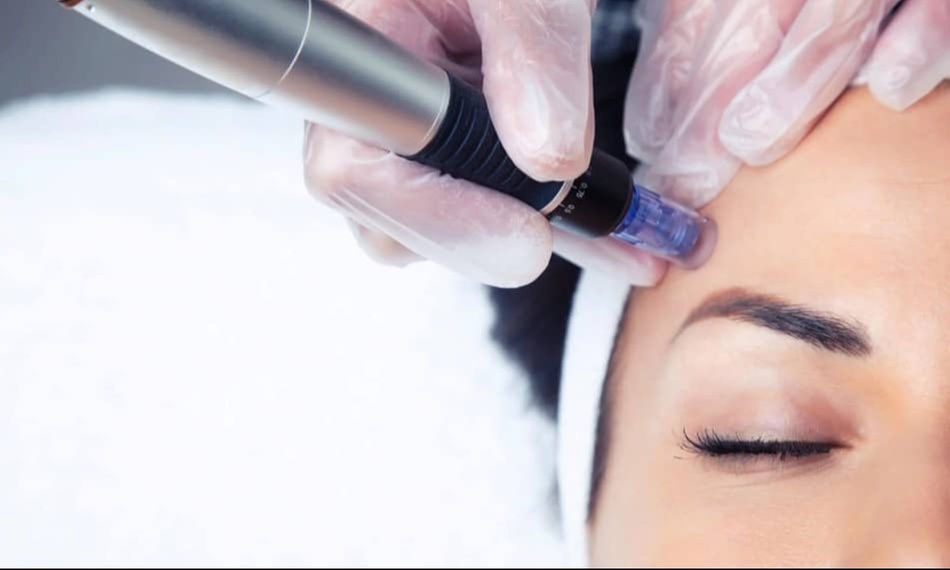 Micro-Needling Treatment for Smoother, Youthful Skin