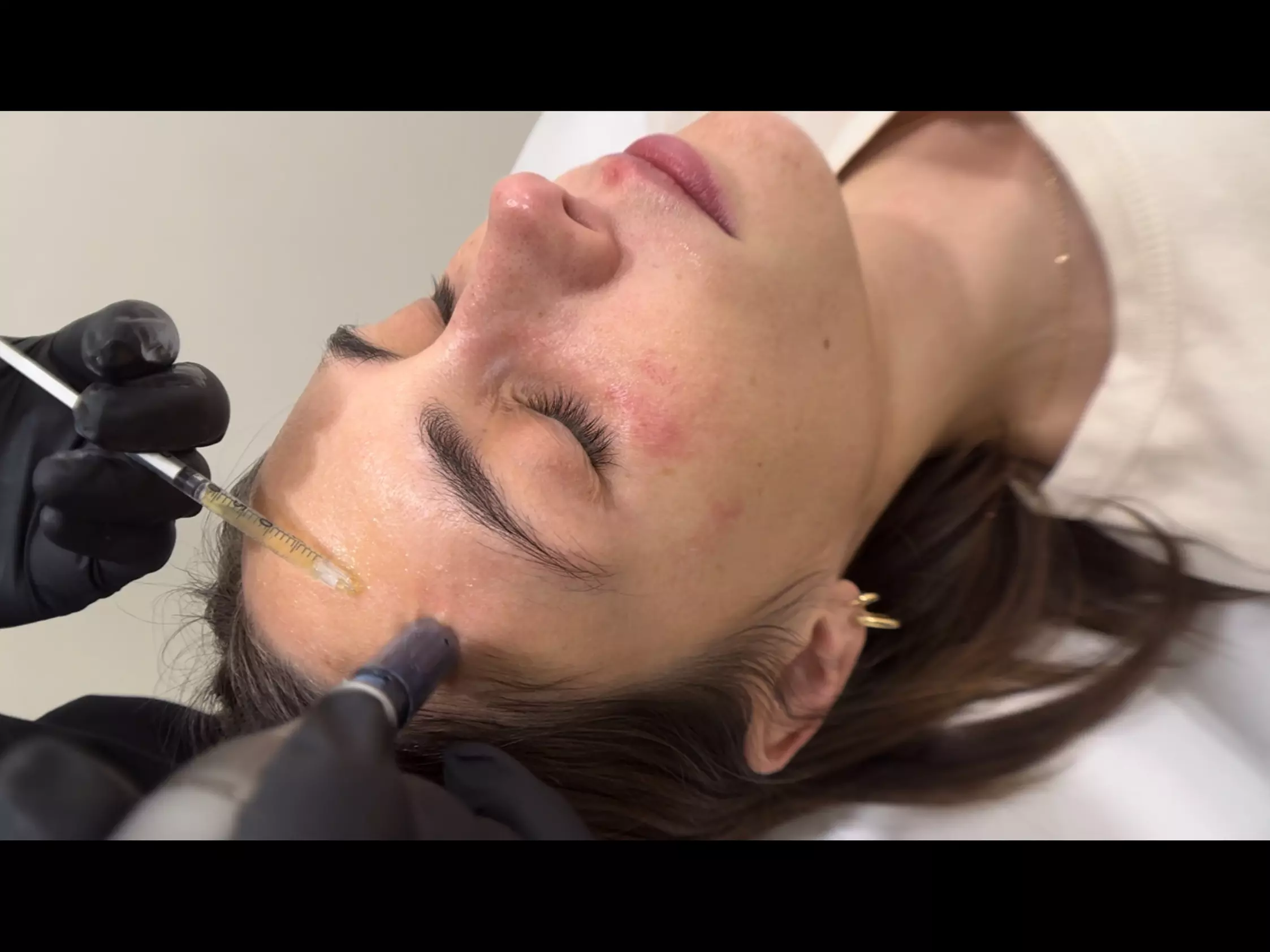 Up to 57% Off on Micro-Needling at Fancy Beauty - Primary Image