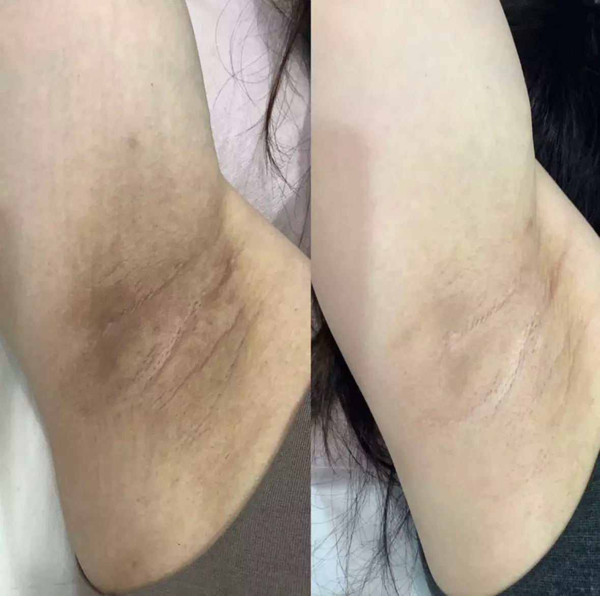 Underarm Sugaring, Full Brazilian Sugar, or Skin Lightening Treatment at Sugar and Smooth Studio (Up to 37% Off) - Primary Image