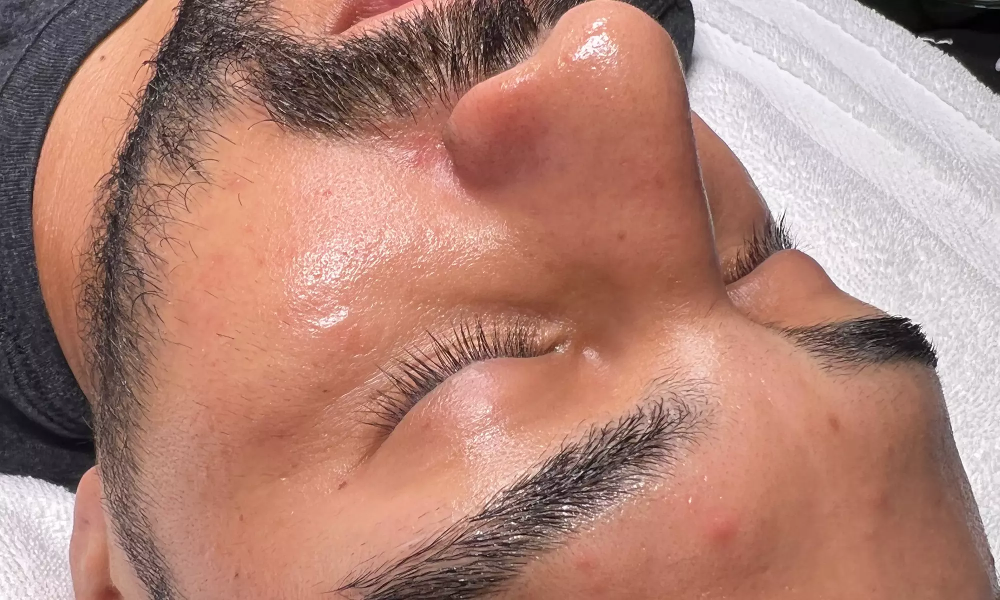 Up to 39% Off on HydraFacial at Amora Med Spa - Second Medium