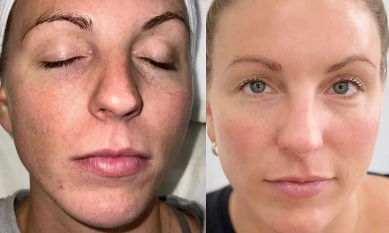 Up to 70% Off on Laser Skin Resurfacing at Le Belle Aesthetic & Laser - Primary Image