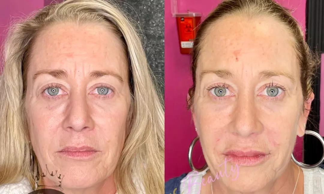 Experience rejuvenation with OBNoxious Beauty's HiFu face lift options, up to 50% off for a youthful glow - Primary Image